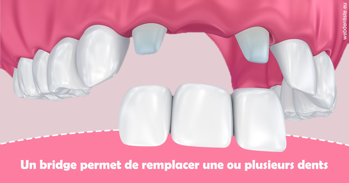 https://selarl-dr-wenger-daniel.chirurgiens-dentistes.fr/Bridge remplacer dents 2