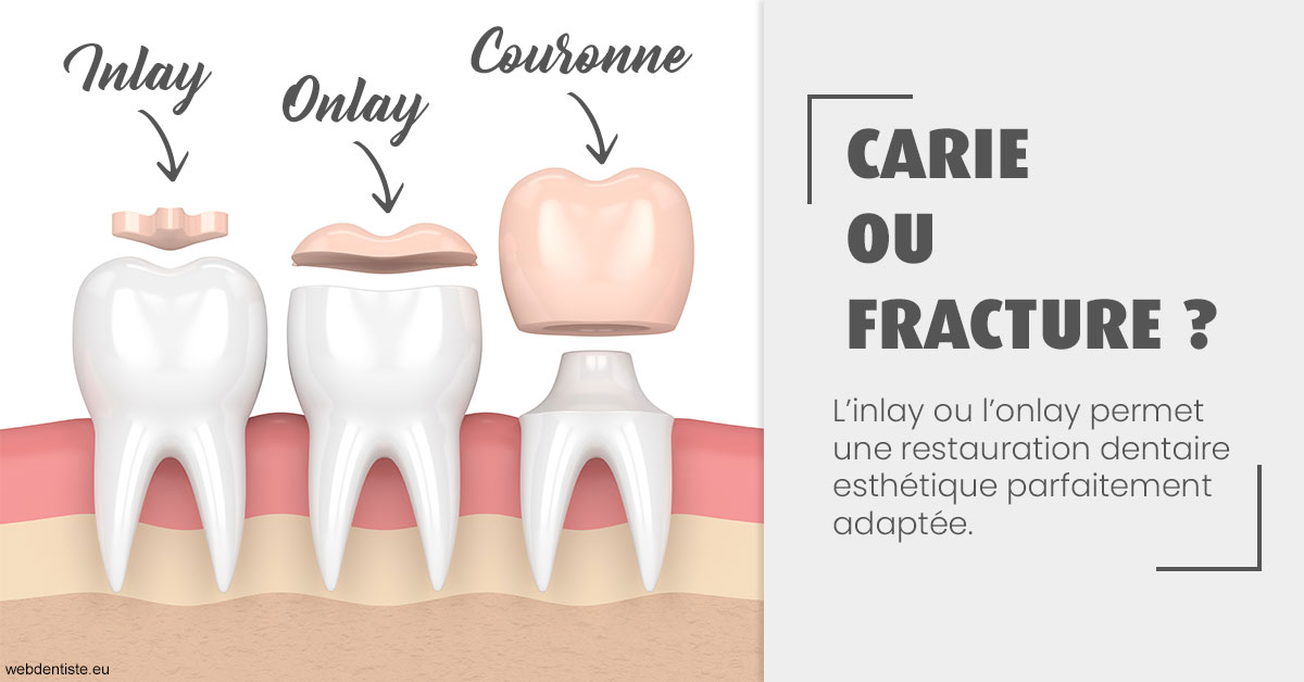 https://selarl-dr-wenger-daniel.chirurgiens-dentistes.fr/T2 2023 - Carie ou fracture 1